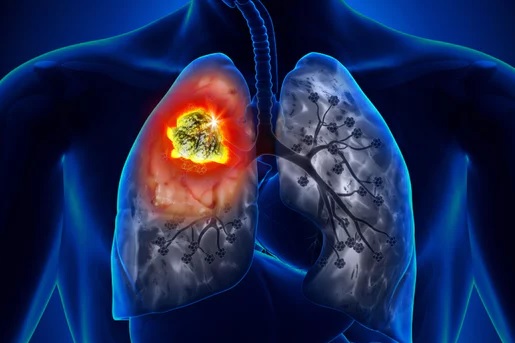 Google's AI system better than humans at spotting lung cancer: Study