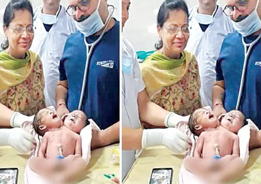 Vidisha: Woman gives birth to baby with two heads, three hands